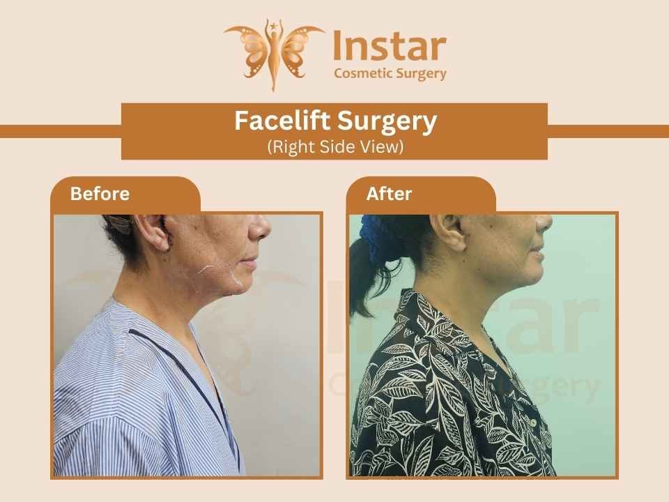 Facelift-Surgery-Right-Side View